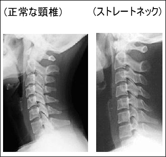 正常な頸椎のレントゲン写真と、ストレートネックのレントゲン写真。